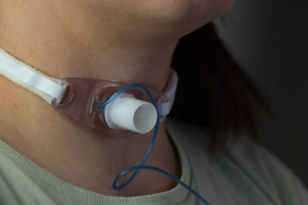 Close up view of a tracheostomy in a adult woman neck. Woman wearing casual clothes with a tracheostomy
